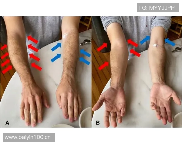 李磊右大腿后群肌肉拉伤及肌筋膜炎I的伤情报告分析与康复建议